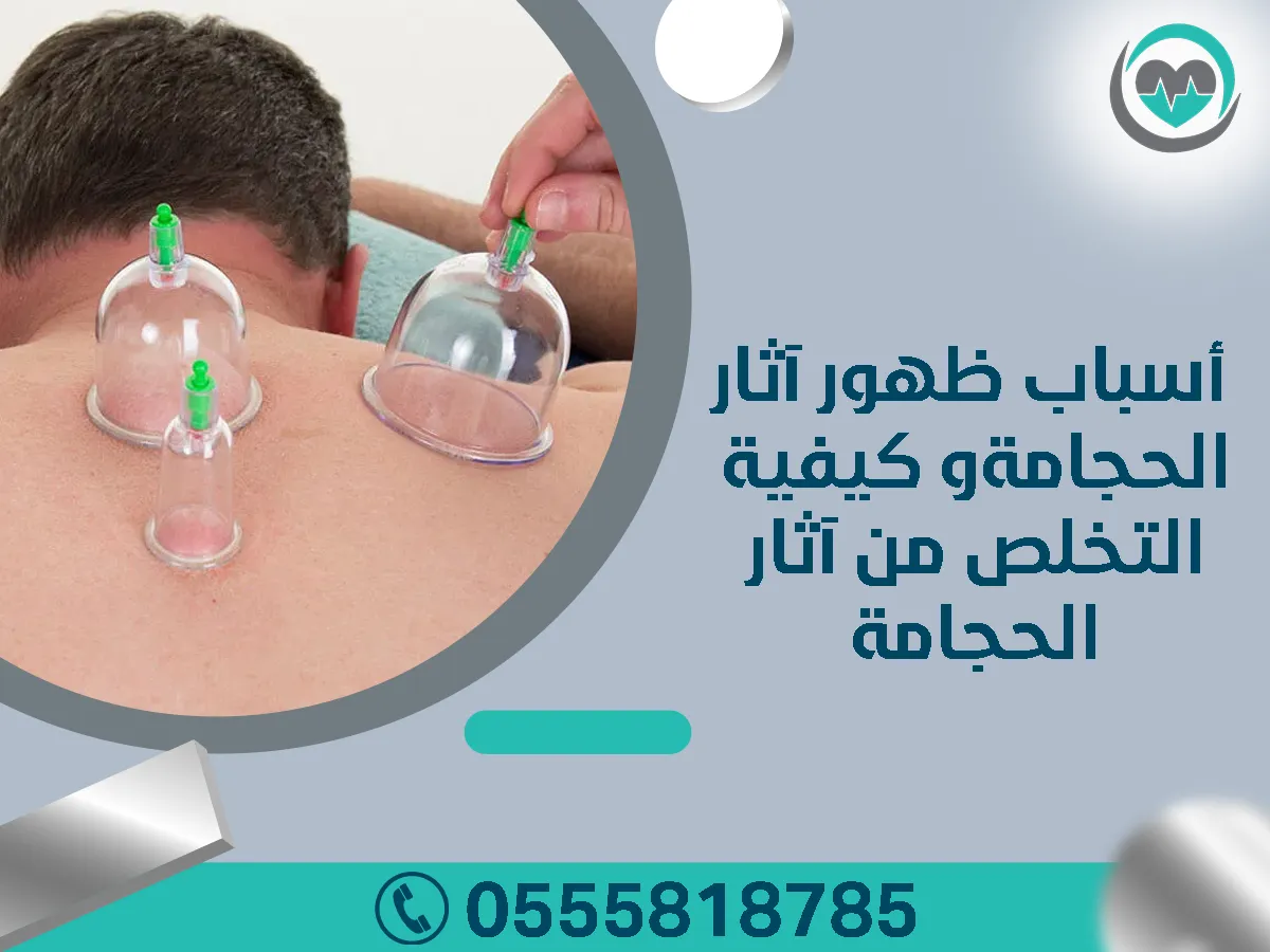 أهم مواضع الحجامة بالجسم