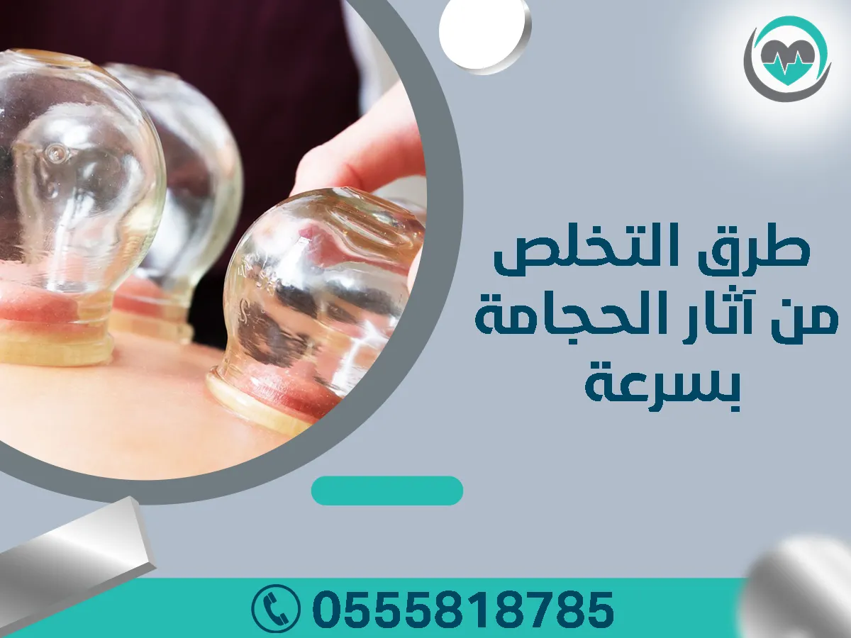 أهم مواضع الحجامة بالجسم
