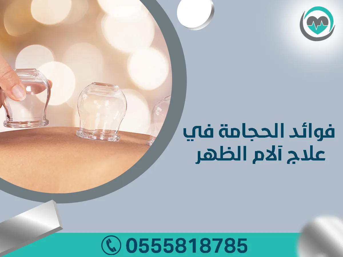 علاج آلام الظهر بالحجامة