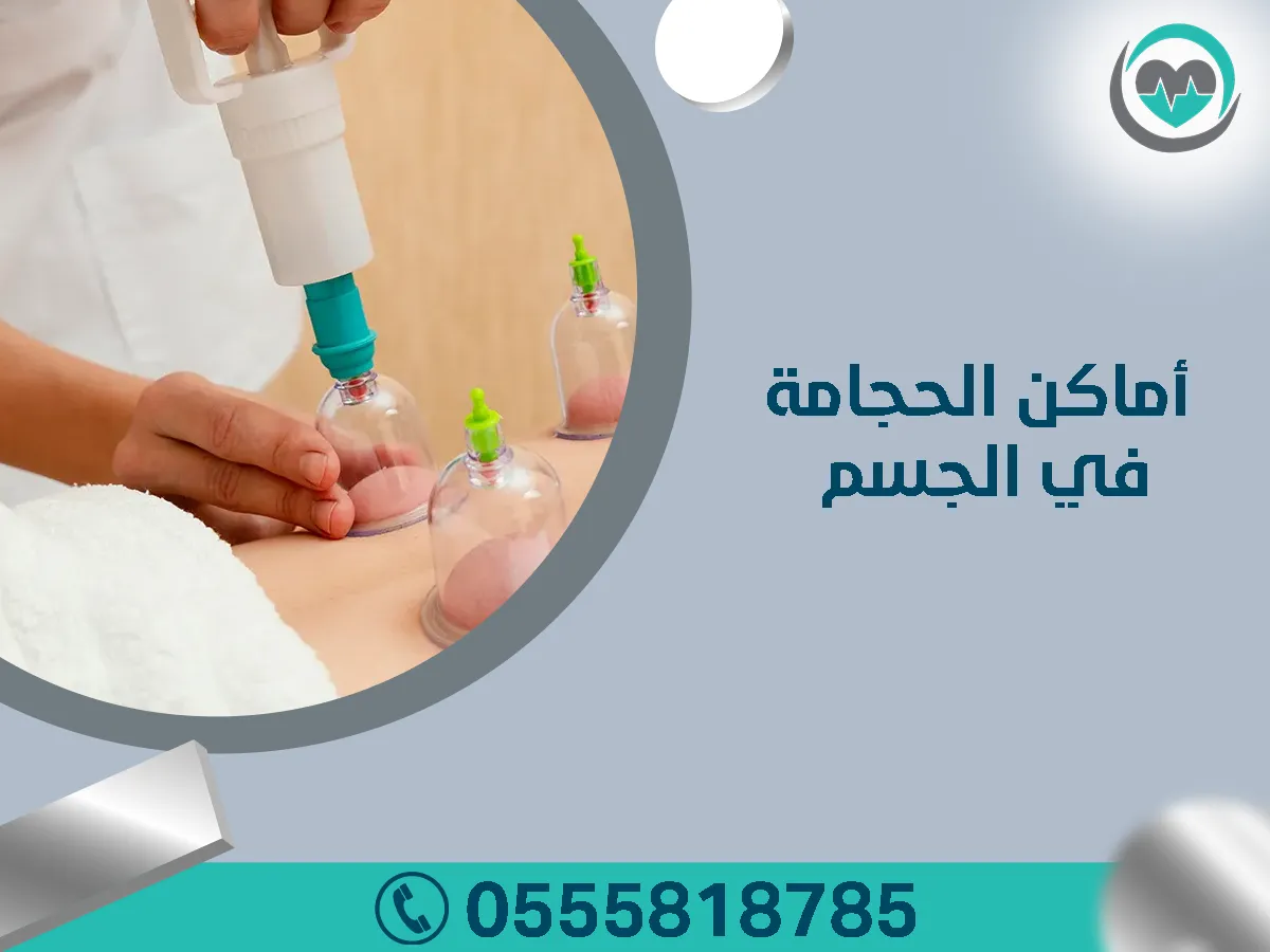 أماكن الحجامة في الجسم بمركز خبراء الحجامة